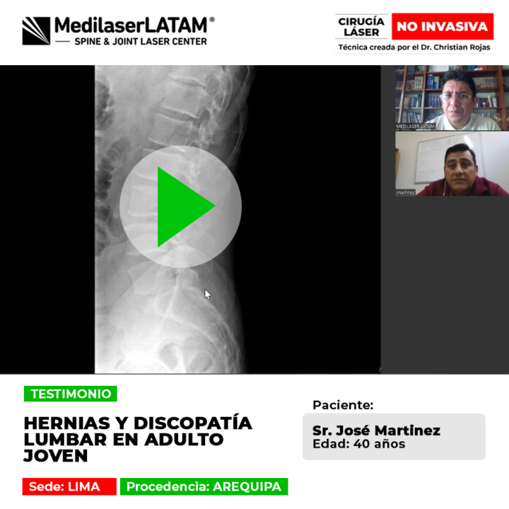 Las hernias y discopatía lumbar pueden limitar fuertemente la vida de adultos jóvenes. Conoce tratamientos eficaces para aliviarlas.