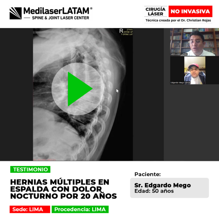 Las hernias múltiples espalda generan dolor crónico nocturno por años. Conoce tratamientos eficaces para lograr un verdadero descanso.
